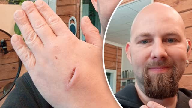 Jouni joutui rajuun ratkaisuun – Ompeli itse haavansa umpeen: ”Muutama kirosana tuli”